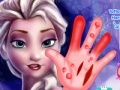 Joc Frozen. Hand surgery