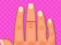 Joc Finger surgery
